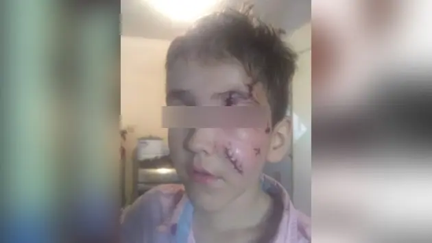 Perro muerde a niño y le causa heridas severas