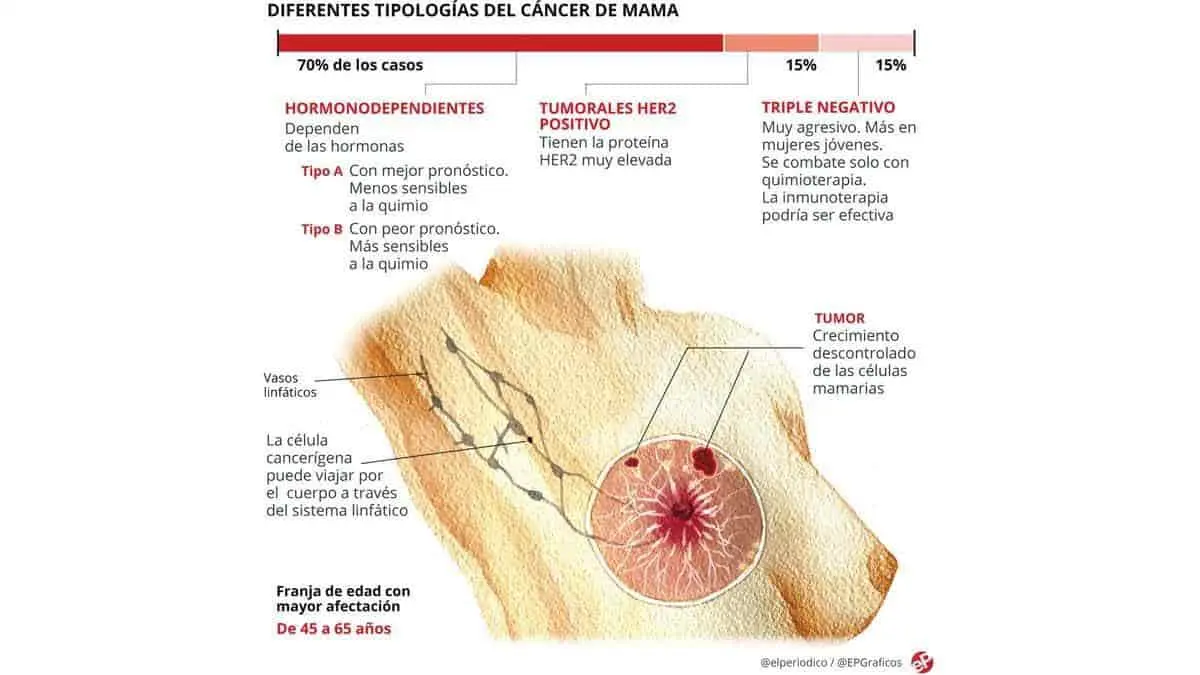 Ataca cáncer de mama a hombres y mujeres