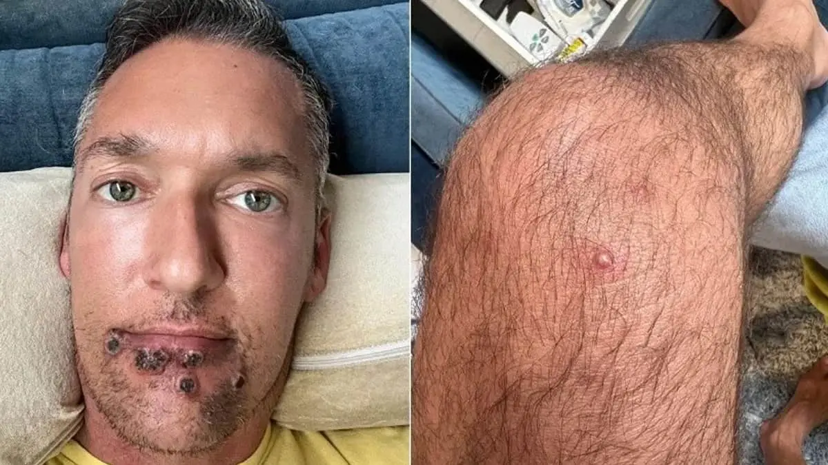 Actor de películas XXX infectado de viruela del mono