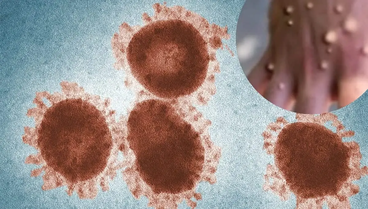 La viruela del mono se ha declarado emergencia de salud pública. Foto: Pexels /CDC