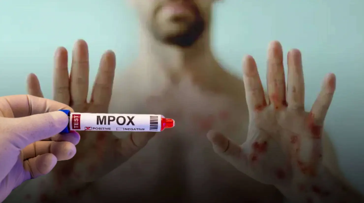 Mpox en Sonora: ¿Ya llegó el virus a la entidad?