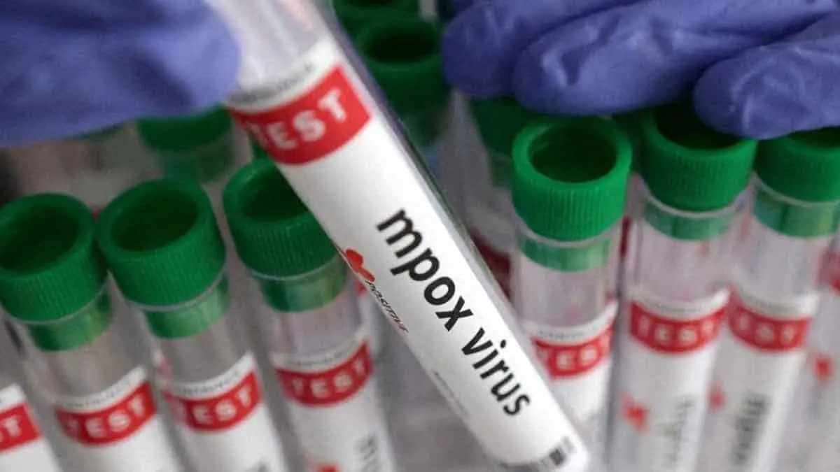 Se registra primer caso de Mpox en Baja California Sur
