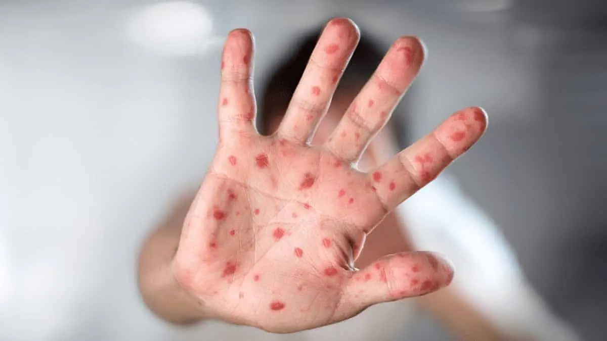 Descarta Salud cinco casos de viruela símica