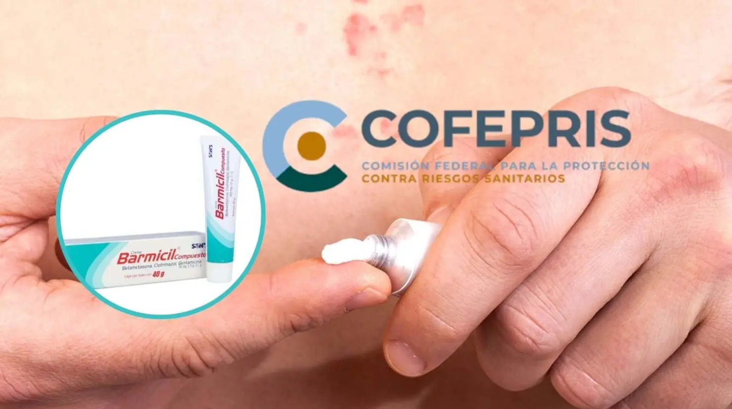 Cofepris alerta sobre el uso de la crema Barmicil ¿Cuáles son las consecuencias a la salud?