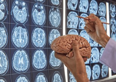 ¿Por qué las enfermedades cerebrales afectan más a las mujeres?