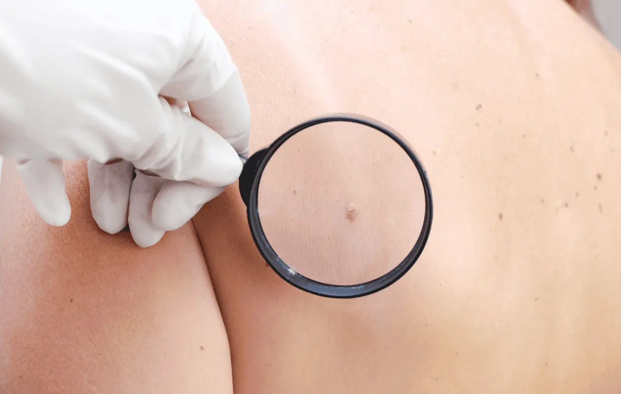 Evitar camas solares para bronceado es una de las recomendaciones que hacen los expertos para disminuir posibilidades de cáncer de piel.