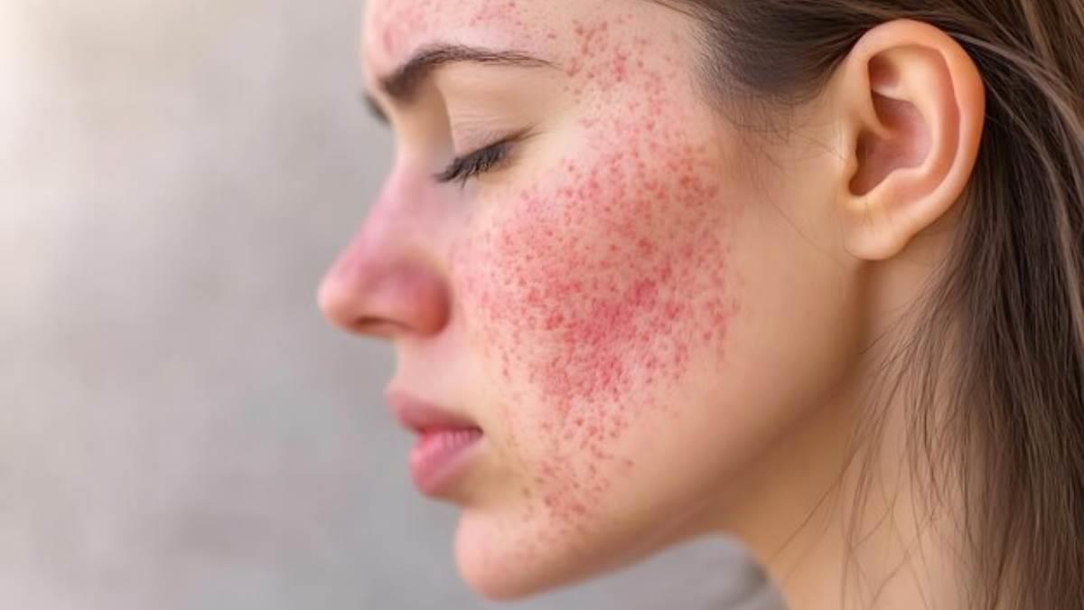 ¿Tienes manchas rojas en la cara? Estos 3 remedios podrían ayudarte a eliminarlas