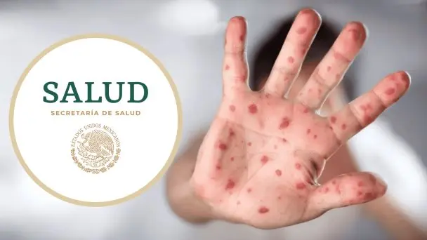 Tras primera muerte de sarampión, previenen la enfermedad en Sonora; ¿qué tan contagioso es?