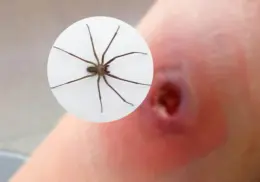 Alerta en México: aumentan casos de mordeduras de la araña violinista en 2025