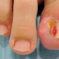 ¿Se te entierran las uñas de los pies constantemente? Así puedes prevenir este problema
