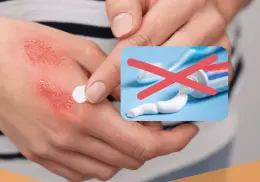 ¿Por qué NO debes aplicar pasta dental en quemaduras? Esto revelan los expertos