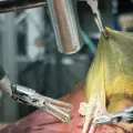 Robot con IA realiza cirugía de vesícula biliar sin asistencia humana por primera vez