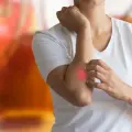 ¿Tienes comezón en una roncha? 3 remedios naturales que ayudan a sobrellevarlo