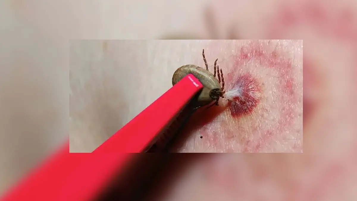 Sube a 45% la letalidad por rickettsia en Navojoa