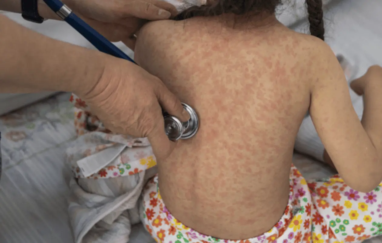 Sarampión en México: OPS eleva a muy alto el riesgo por brote