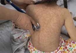 Sarampión en México: OPS eleva a muy alto el riesgo por brote Sarampión en México: OPS eleva a muy alto el riesgo por brote