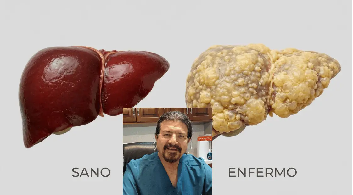 Advierte médico sobre hígado graso
