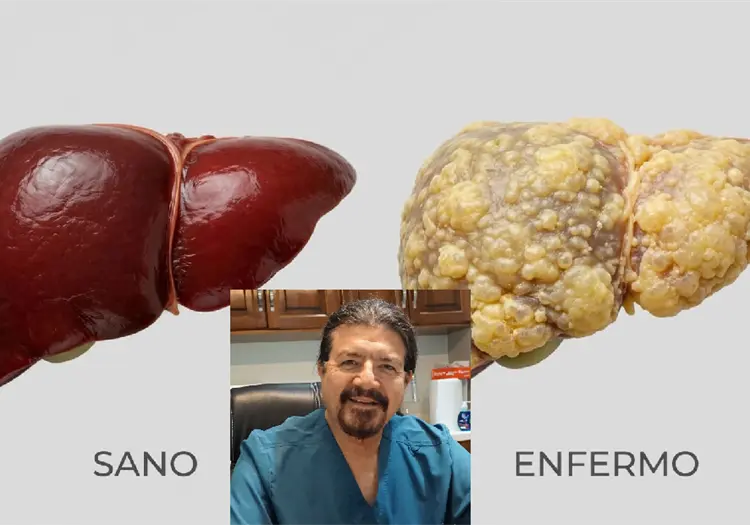 Advierte médico sobre hígado graso