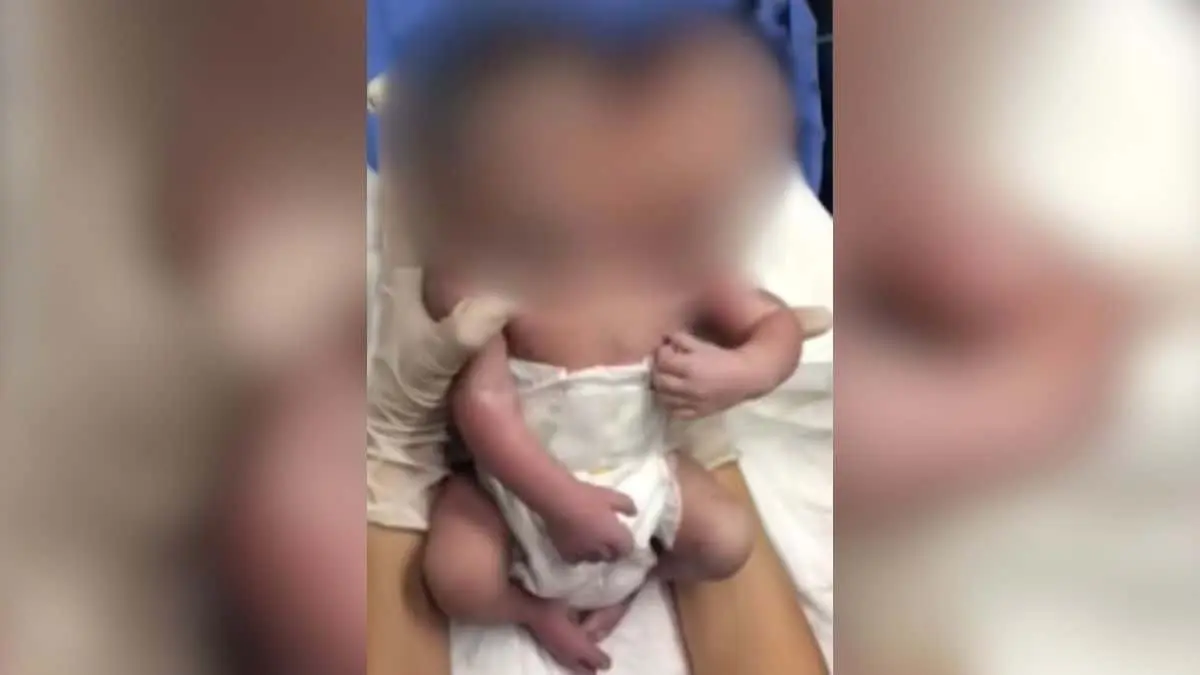 VIDEO | Filtran nacimiento de un bebé de 2 cabezas en Ciudad Juárez