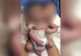 VIDEO | Filtran nacimiento de un bebé de 2 cabezas en Ciudad Juárez