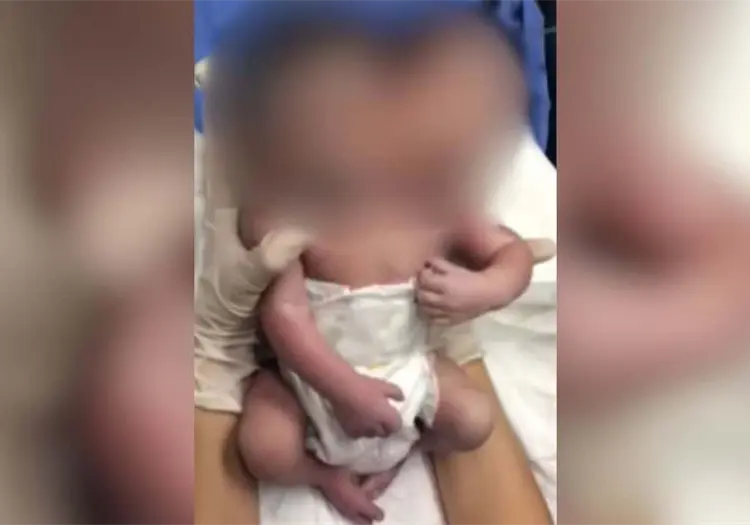 VIDEO | Filtran nacimiento de un bebé de 2 cabezas en Ciudad Juárez